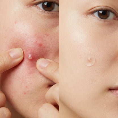 NoxPatch  "Acuéstate con un brote activo, despierta con la piel lisa y libre de pus."
